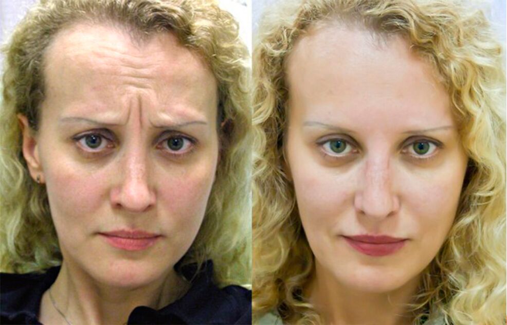 przed i po użyciu masażera do odmładzania ltza fot. 1