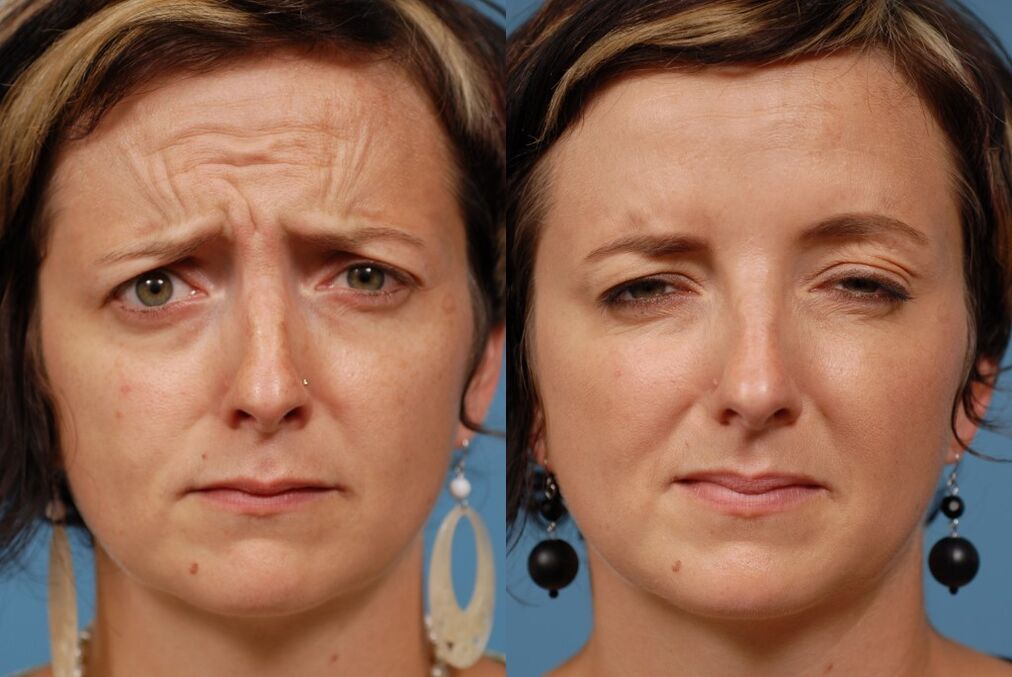 przed i po użyciu masażera do odmładzania ltza fot. 2