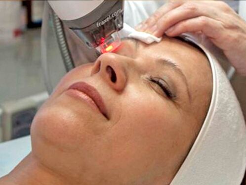 laserowe odmładzanie skóry wokół oczu