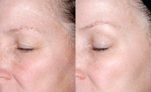 odmłodzenie skóry wokół oczu przed i po zdjęciach