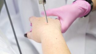 Laserowe odmładzanie skóry dłoni