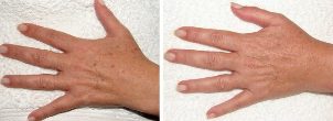 Rezultat usunięcia plam starczych na dłoniach