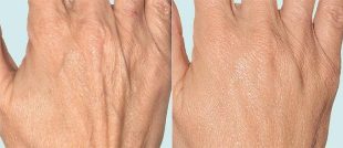 Skóra dłoni przed i po terapii frakcyjnej