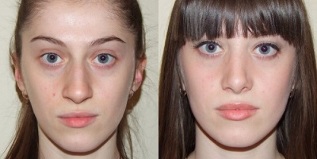 przed i po plazmowym odmładzaniu skóry