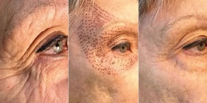 zdjęcia przed i po plazmowym odmładzaniu skóry